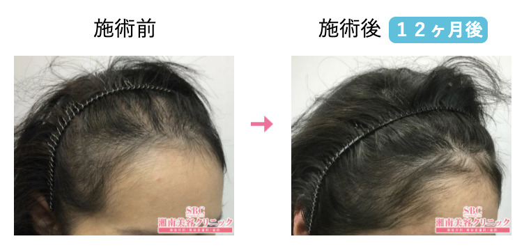 びまん性脱毛症の治療前と治療後の比較画像